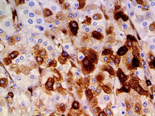 IHC of Osteonectin / SPARC on an FFPE Pancreas Tissue